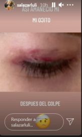 Luciana Salazar mostró cómo le quedó el ojo tras su accidente