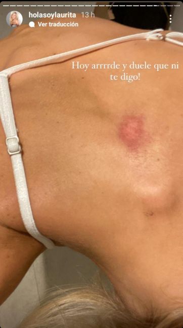 Laurita Fernández mostró la terrible herida tras su presentación en La Academia