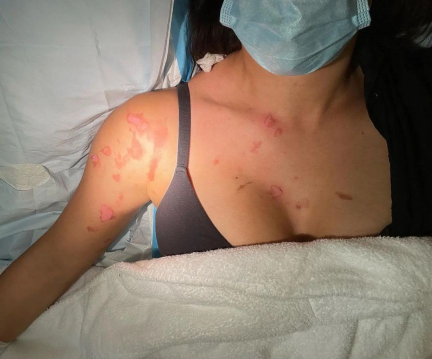 Eva De Dominici impactó a sus seguidores con fotos de las graves quemaduras que sufrió tras un accidente