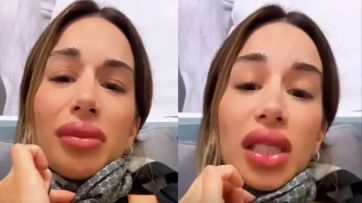 Estefi Berardi sufrió una reacción alérgica que deformó parte de su rostro: las impactantes imágenes