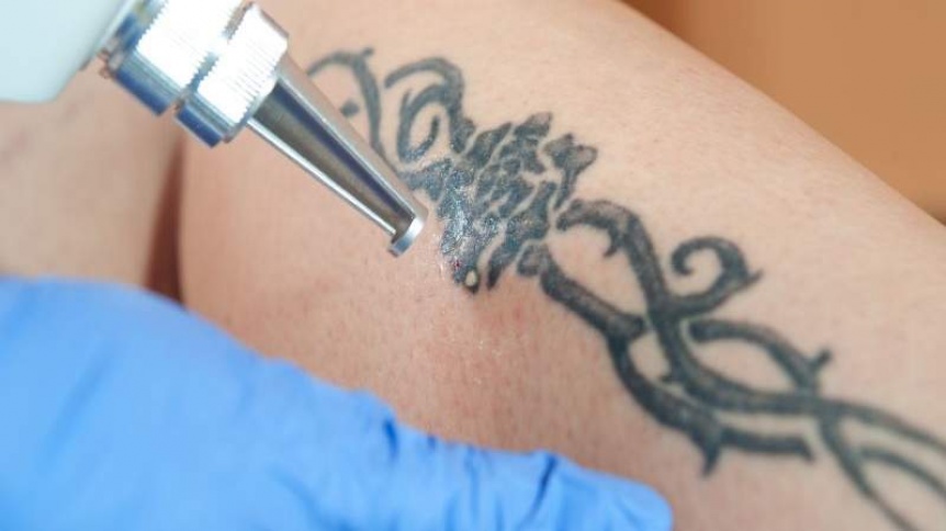 Conocé las técnicas y tratamientos para la eliminación de tatuajes
